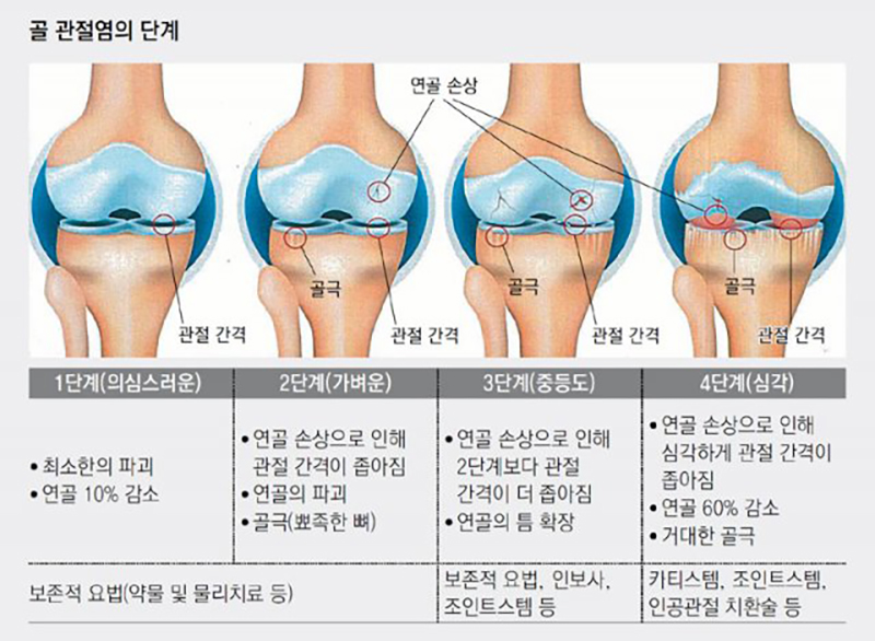 골 관절염의 단계 설명